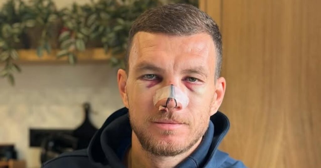 Fenerbahçe’li Edin Dzeko’nun Sakatlık Paylaşımı