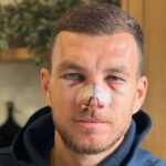Fenerbahçe’li Edin Dzeko’nun Sakatlık Paylaşımı